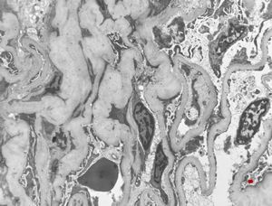 M,29y. | developing glomerulosclerosis